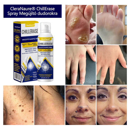 🔥Készlet fogy, mielőtt elfogy! CleraNaure® ChillErase dudorjavító spray
