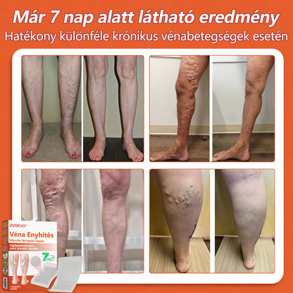 ☘️ Zvoevo® Vein Ease mikro-tűs ápoló tapasz (pókgerincvénák, visszér, duzzanat, fáradt lábak kezelésére)📦