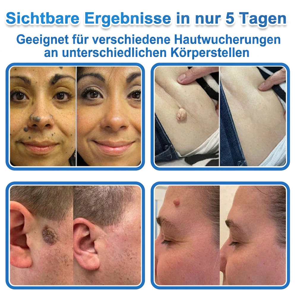 🏆Celsiora® 2-in-1 Mikronadel- & Hydrokolloid-Pflaster | Entferner für erhabene Muttermale, Akne, flache Warzen & Hautanhängsel | Verbessert Falten, Narben & Hautunreinheiten | Unsichtbare Stern-Pickelpflaster für Gesicht & Körper