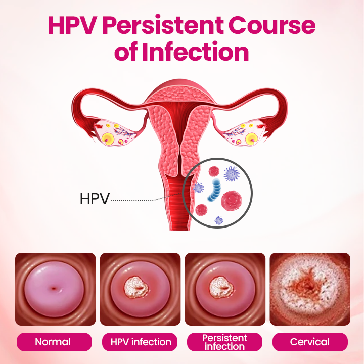 🏆 Breakthrough in Women’s Intimate Health! Feel Relief in Just 3 Days with Multi-Targeted HPV Defense