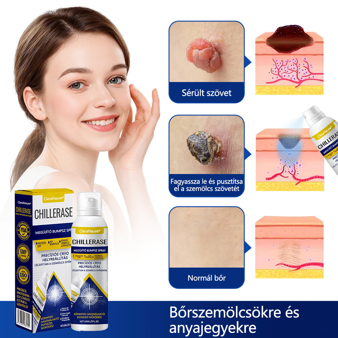 🔥Készlet fogy, mielőtt elfogy! CleraNaure® ChillErase dudorjavító spray