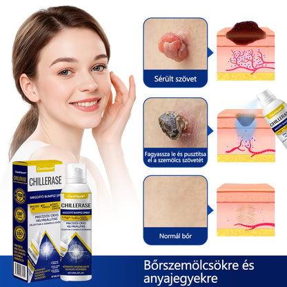 🔥Készlet fogy, mielőtt elfogy! CleraNaure® ChillErase dudorjavító spray