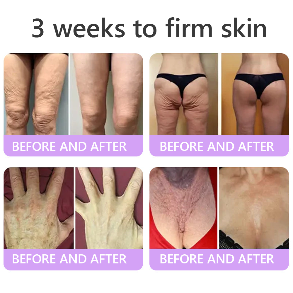 𝐇𝐈𝐒𝐊𝐈𝐍® 𝐏𝐃𝐑𝐍 𝐌𝐮𝐥𝐭𝐢-𝐏𝐞𝐩𝐭𝐢𝐝𝐞 𝐌𝐚𝐬𝐬𝐚𝐠𝐢𝐧𝐠 𝐁𝐨𝐝𝐲 𝐑𝐨𝐥𝐥𝐞𝐫 𝐂𝐫𝐞𝐚𝐦- Anti-aging, Hydrating, Skin Firming & Lifting, Skin Repair, Even Tone, Acne and Dark Spot Treatment, Wart and Mole Removal, and Psoriasis Relief.