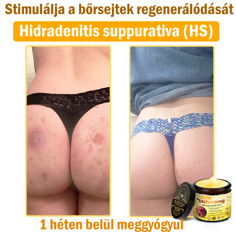 🐝PUROSA® Méhméreg Bőrregeneráló Krém | Teljes körű megoldás makacs bőrproblémákra, például öregedés, ekcéma, hegek és pikkelysömör ellen 🌿✨