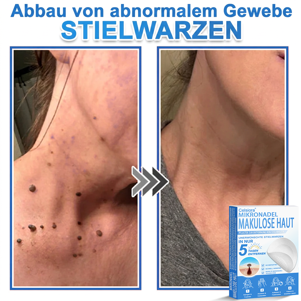 🏆Celsiora® 2-in-1 Mikronadel- & Hydrokolloid-Pflaster | Entferner für erhabene Muttermale, Akne, flache Warzen & Hautanhängsel | Verbessert Falten, Narben & Hautunreinheiten | Unsichtbare Stern-Pickelpflaster für Gesicht & Körper