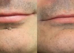 ✨Rainiste®2-in-1 Microneedle & Hydrocolloid Patch🍀| Removes Raised Moles, Acne, Flat Warts & Skin Tags | Helps Improve Wrinkles, Scars & Blemishes | Invisible Patches for Face & Body