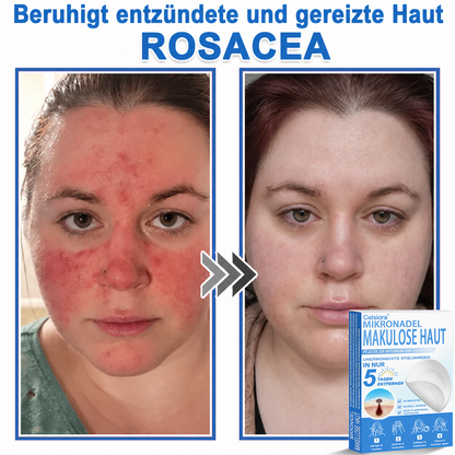 🏆Celsiora® 2-in-1 Mikronadel- & Hydrokolloid-Pflaster | Entferner für erhabene Muttermale, Akne, flache Warzen & Hautanhängsel | Verbessert Falten, Narben & Hautunreinheiten | Unsichtbare Stern-Pickelpflaster für Gesicht & Körper