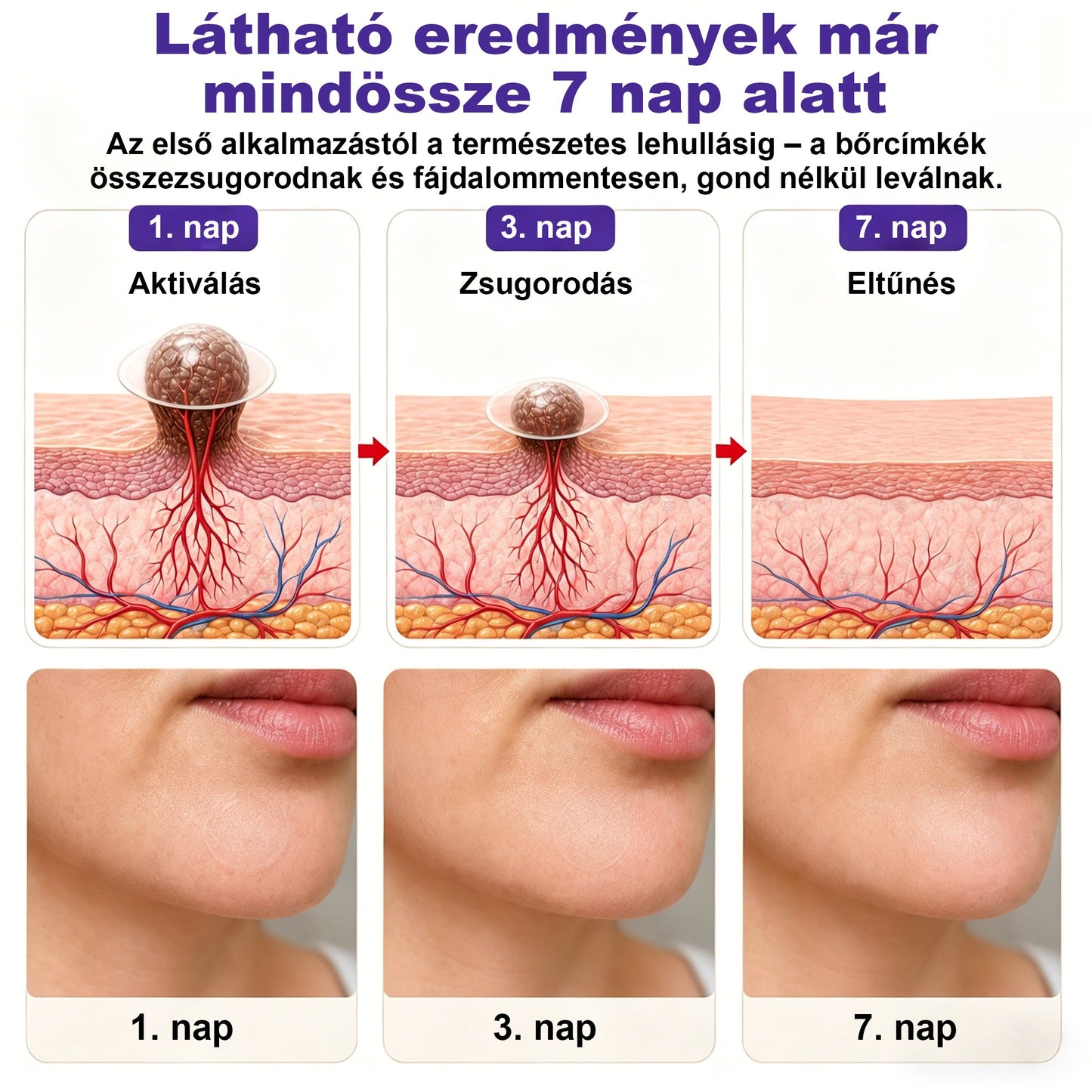 🌟CleraNaure® mikrotűs szemölcs- és anyajegyeltávolító tapasz