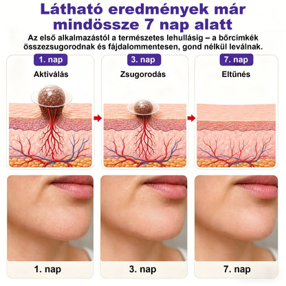🌟CleraNaure® mikrotűs szemölcs- és anyajegyeltávolító tapasz