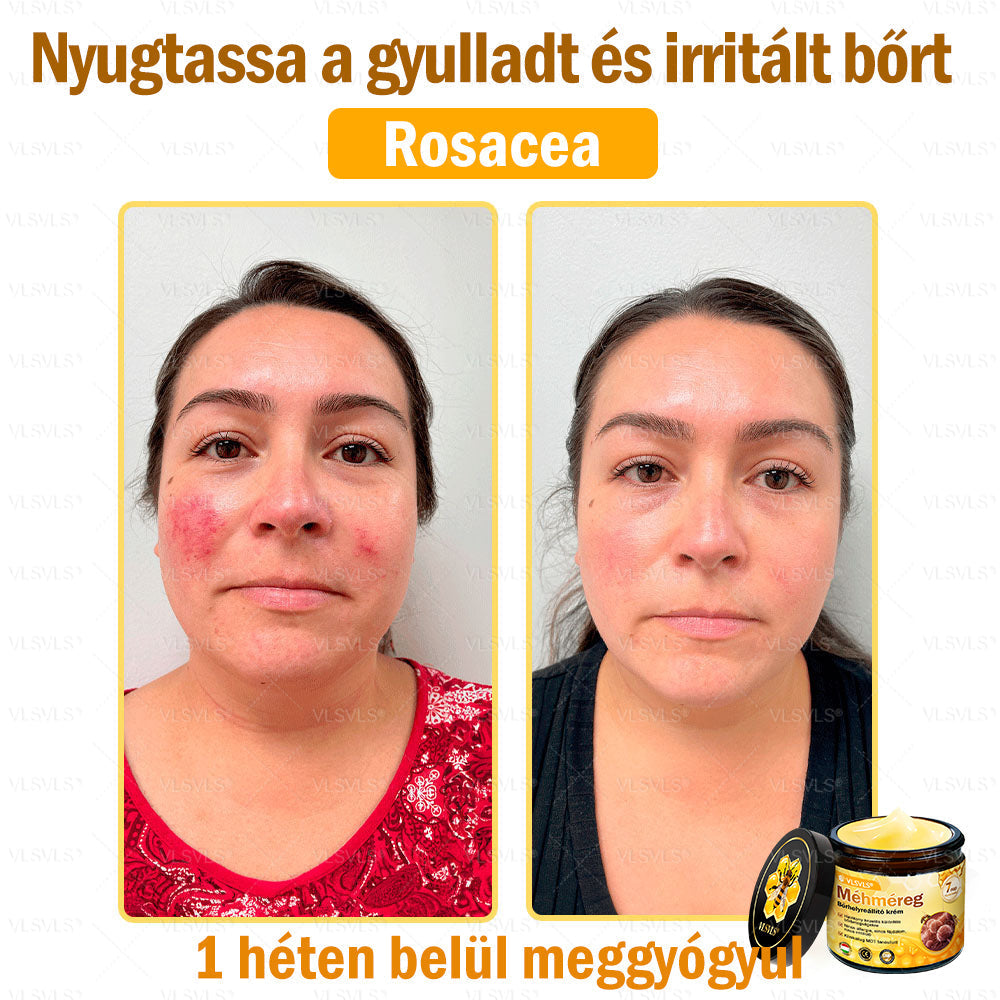 VLSVLS® Méhméreg Börhelyreállító Krém(CEjóváhagyott)