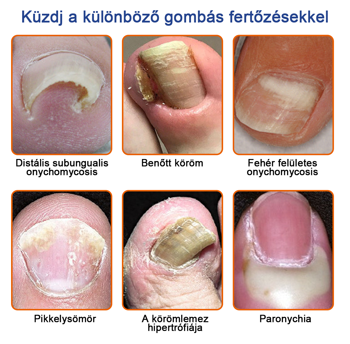 🐝Furzero™ Méhméreg Körömgomba Kezelő Oldat: Teljes megoldás a körömgomba problémájára
