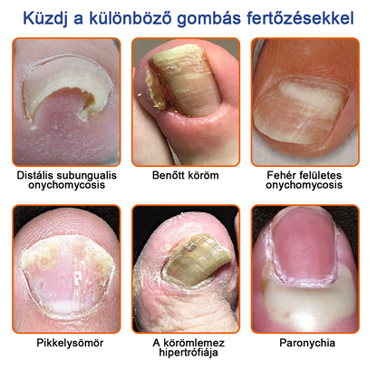 🐝Furzero™ Méhméreg Körömgomba Kezelő Oldat: Teljes megoldás a körömgomba problémájára