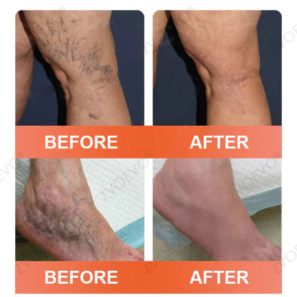 🌿❤️Celsiora® Vein Ease Microneedle Care Patch(For Spider Veins, Varicose Veins, Swelling & Leg Fatigue) - Last Day Promotion 50% OFF
