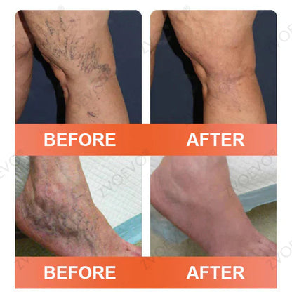 🌿❤️Celsiora® Vein Ease Microneedle Care Patch(For Spider Veins, Varicose Veins, Swelling & Leg Fatigue) - Last Day Promotion 50% OFF