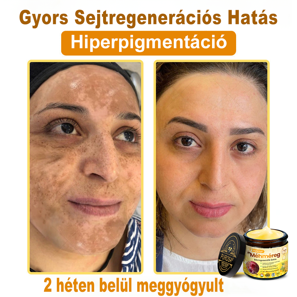 🐝PUROSA® Méhméreg Bőrregeneráló Krém | Teljes körű megoldás makacs bőrproblémákra, például öregedés, ekcéma, hegek és pikkelysömör ellen 🌿✨