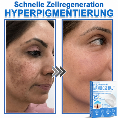🏆Celsiora® 2-in-1 Mikronadel- & Hydrokolloid-Pflaster | Entferner für erhabene Muttermale, Akne, flache Warzen & Hautanhängsel | Verbessert Falten, Narben & Hautunreinheiten | Unsichtbare Stern-Pickelpflaster für Gesicht & Körper