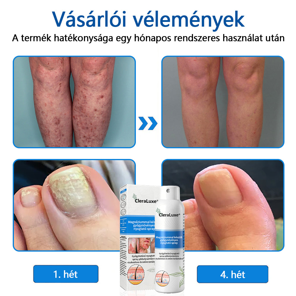 CleraLuxe®  Magnézium Gyógynövényes Pszoriázis Spray📦