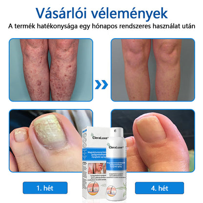 CleraLuxe®  Magnézium Gyógynövényes Pszoriázis Spray📦