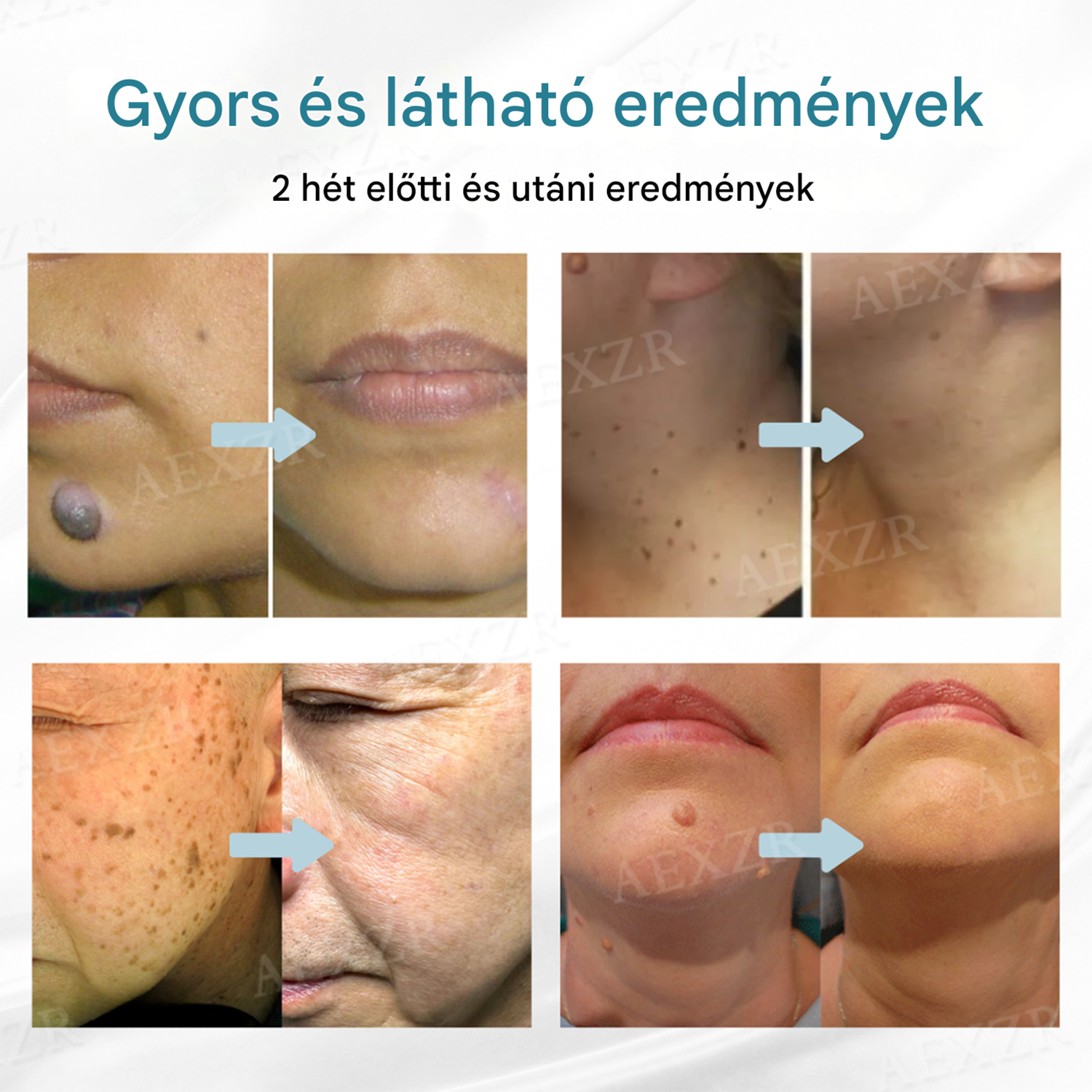 [⚡️A mai legjobb ajánlatok]🔥Bikenda® non-invazivanyajegy- ésszemölcseltávolítÃó lézertol