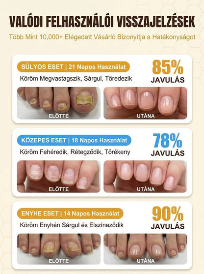 ✨[7 Napos Csodás Körömfényesítés]🐝 Méhméreg Prémium Körömápoló Cseppek