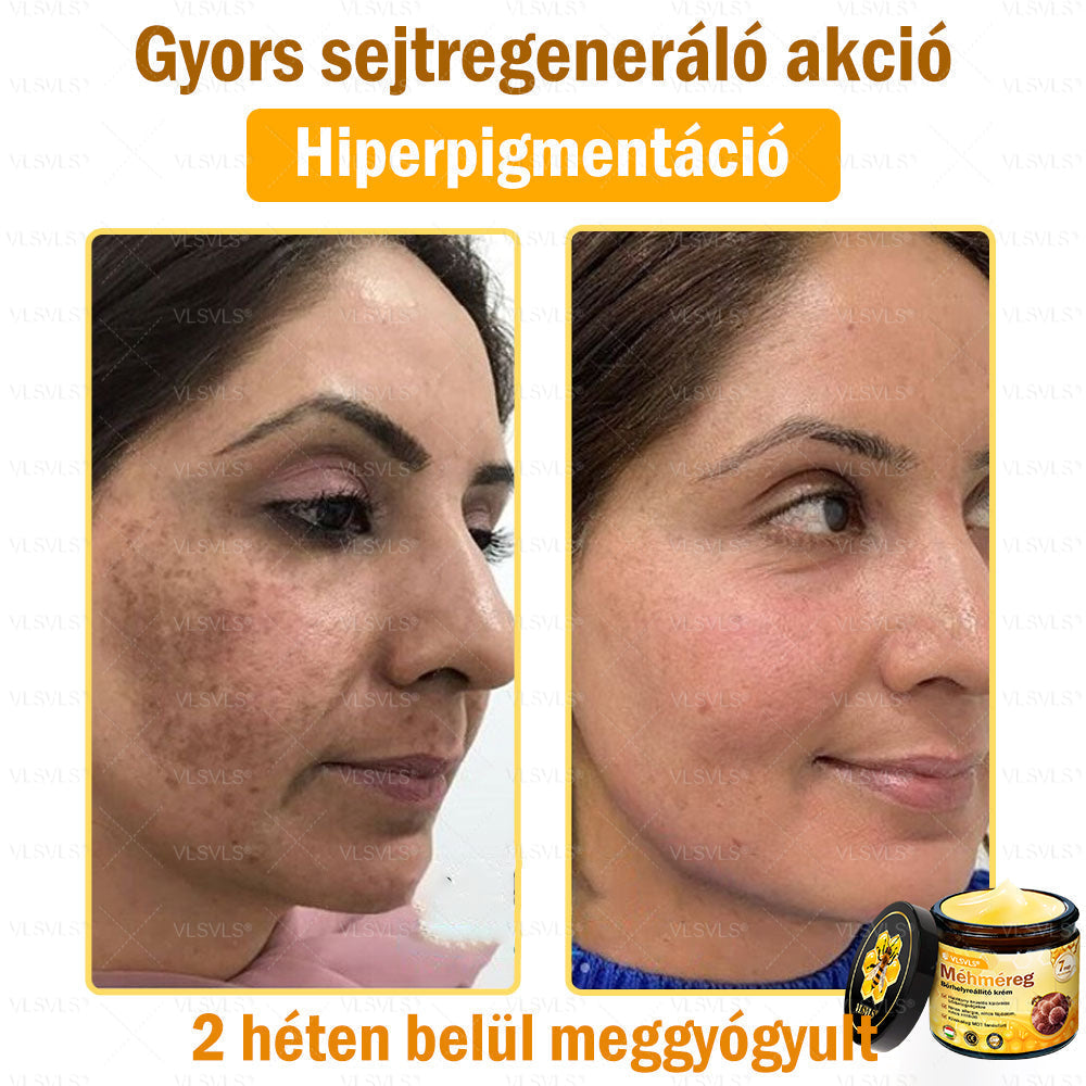 💜💜VLSVLS® Méhméreg Bőrhelyreállító Krém (👨‍⚕‍CE jóváhagyott)👍✅