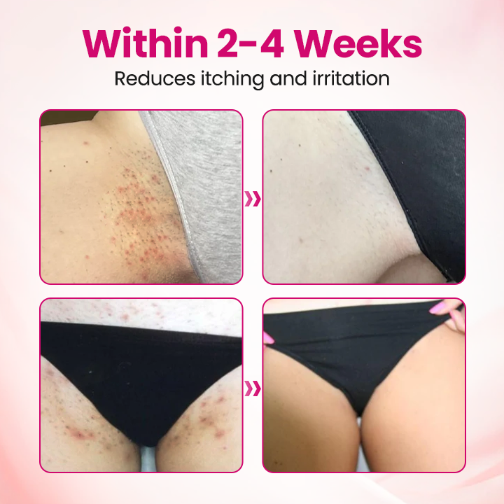 🏆 Breakthrough in Women’s Intimate Health! Feel Relief in Just 3 Days with Multi-Targeted HPV Defense