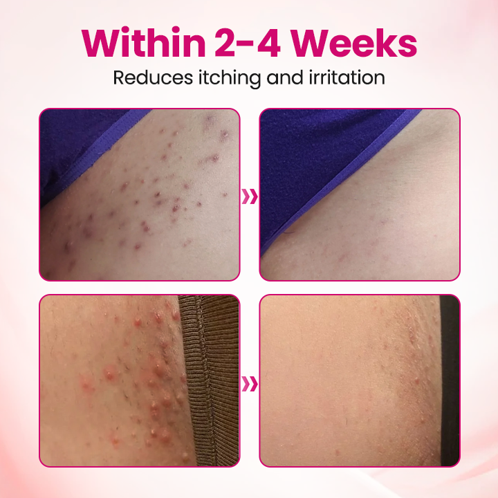 🏆 Breakthrough in Women’s Intimate Health! Feel Relief in Just 3 Days with Multi-Targeted HPV Defense