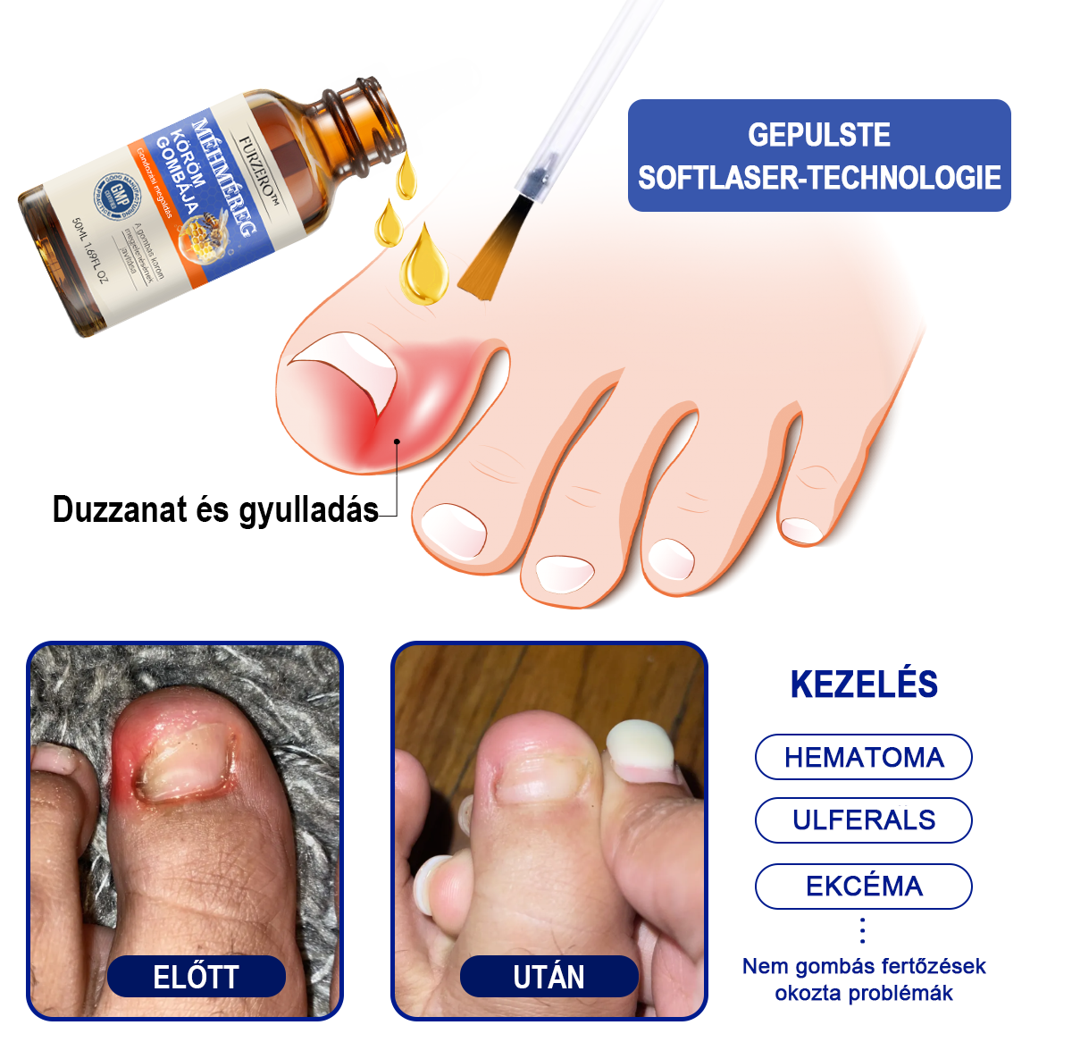 🐝Furzero™ Méhméreg Körömgomba Kezelő Oldat: Teljes megoldás a körömgomba problémájára