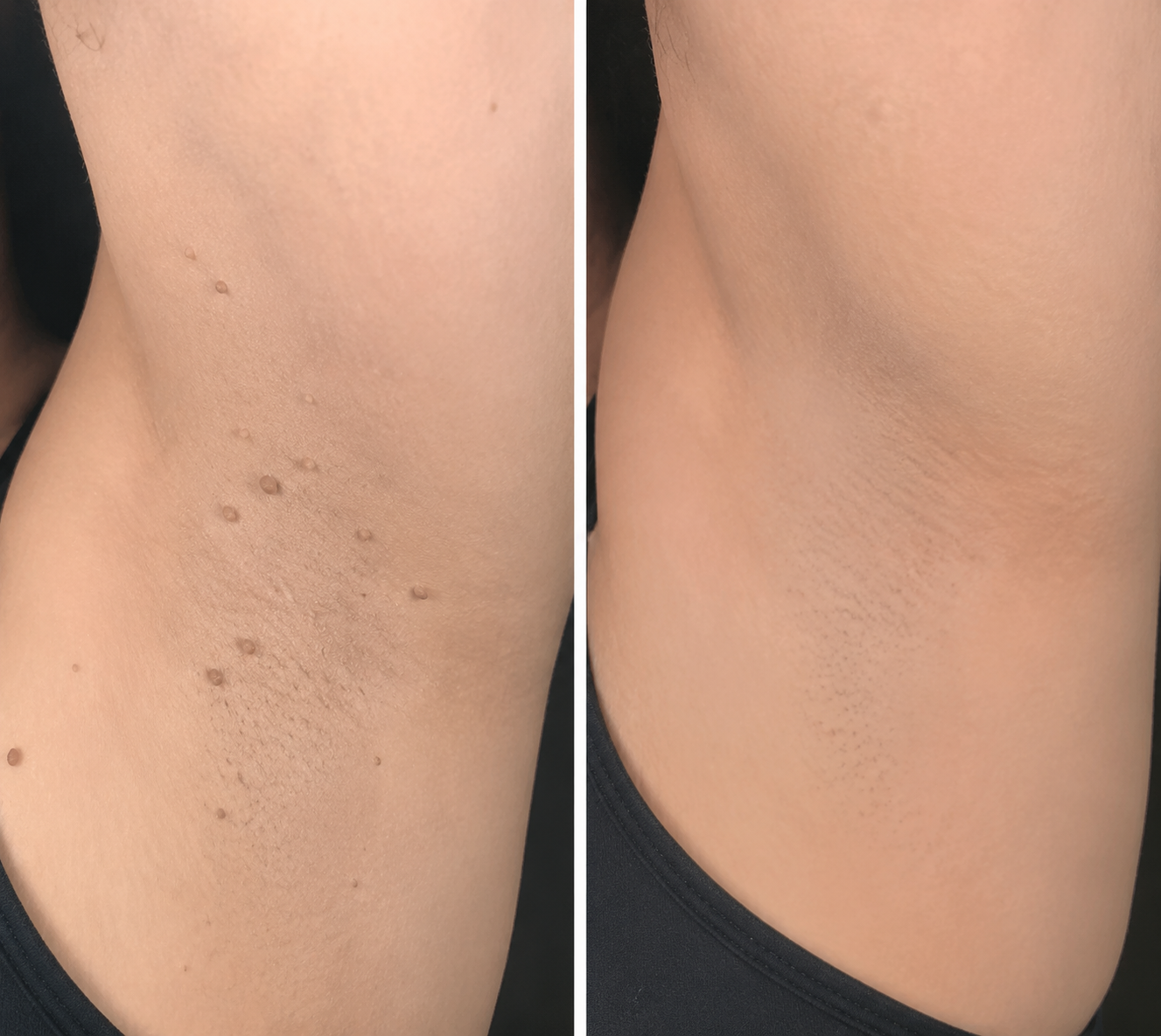 ✨Rainiste®2-in-1 Microneedle & Hydrocolloid Patch🍀| Removes Raised Moles, Acne, Flat Warts & Skin Tags | Helps Improve Wrinkles, Scars & Blemishes | Invisible Patches for Face & Body