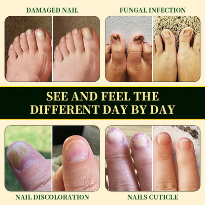 BeamBalm® Tolnaftate Nail Fungus Solution | For Fingernails & Toenails