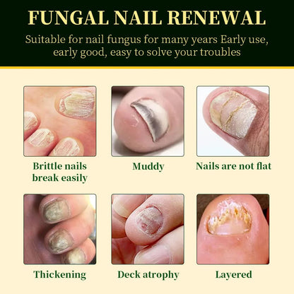 BeamBalm® Tolnaftate Nail Fungus Solution | For Fingernails & Toenails