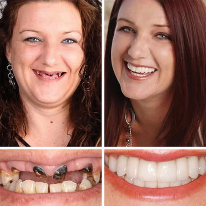 Ends Today: 70% OFF! ⏰70% OFF! KLENIMORE™ Medical Full Denture with Strong Suctiond Custom-Fit Full Functional Dentures🦷Obtain American Dental Association (ADA) Certification