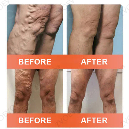 🌿❤️Celsiora® Vein Ease Microneedle Care Patch(For Spider Veins, Varicose Veins, Swelling & Leg Fatigue) - Last Day Promotion 50% OFF