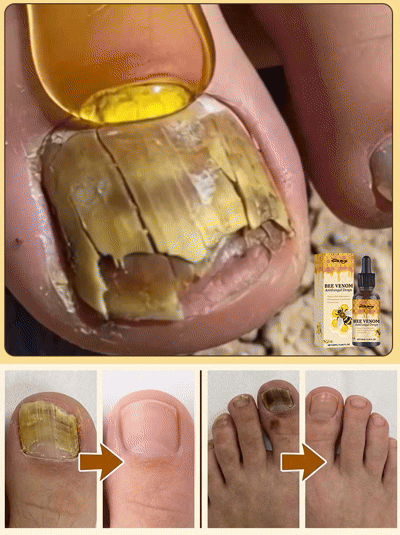 ✨[7 Napos Csodás Körömfényesítés]🐝 Méhméreg Prémium Körömápoló Cseppek